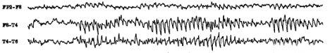 epilepsy_eeg_trace.jpg