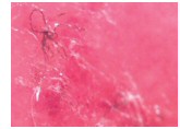morgellons_article_image.jpg