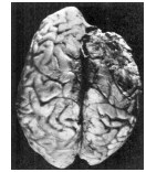 Ruth Wilder postmortem brain